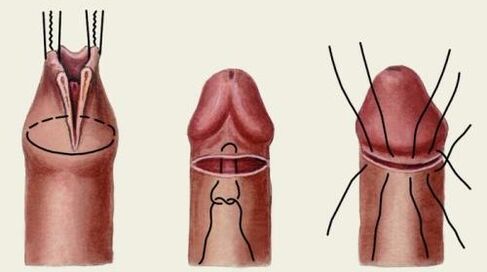 Hoe wordt penisplastische chirurgie uitgevoerd