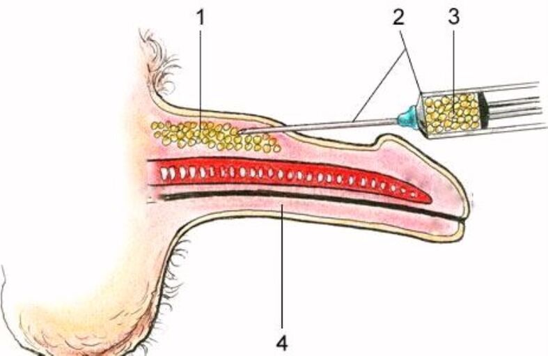 injectie penisvergroting